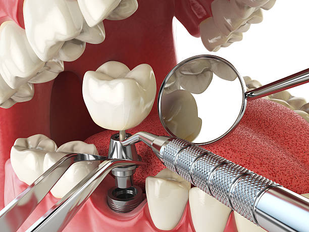 Best Cracked Tooth Emergency Dentist  in Ridgemark, CA